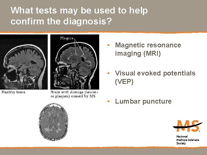 What tests may be used to help confirm the diagnosis? • Magnetic resonance imaging