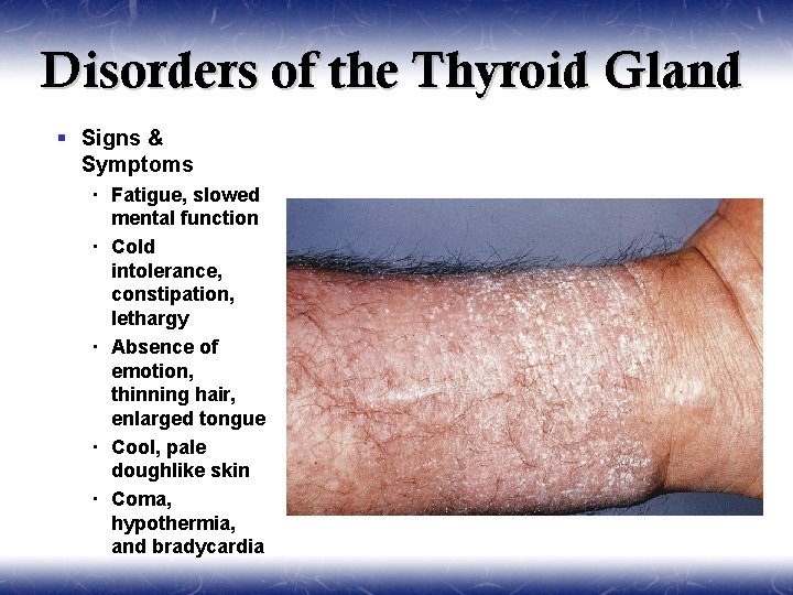 Disorders of the Thyroid Gland § Signs & Symptoms Fatigue, slowed mental function Cold