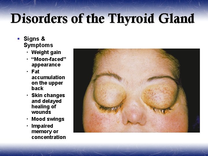 Disorders of the Thyroid Gland § Signs & Symptoms Weight gain “Moon-faced” appearance Fat