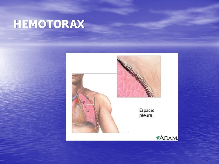 HEMOTORAX 