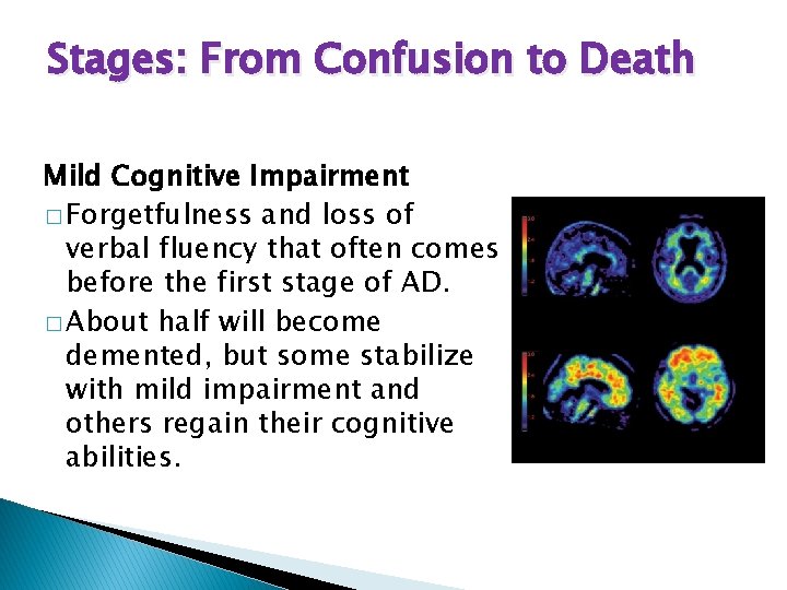 Stages: From Confusion to Death Mild Cognitive Impairment � Forgetfulness and loss of verbal