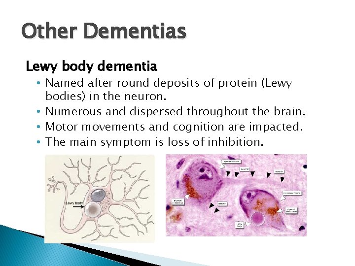 Other Dementias Lewy body dementia • Named after round deposits of protein (Lewy bodies)