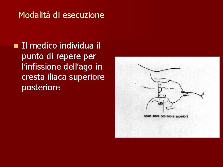 Modalità di esecuzione n Il medico individua il punto di repere per l’infissione dell’ago