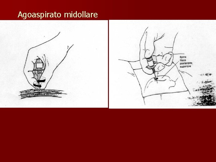 Agoaspirato midollare 