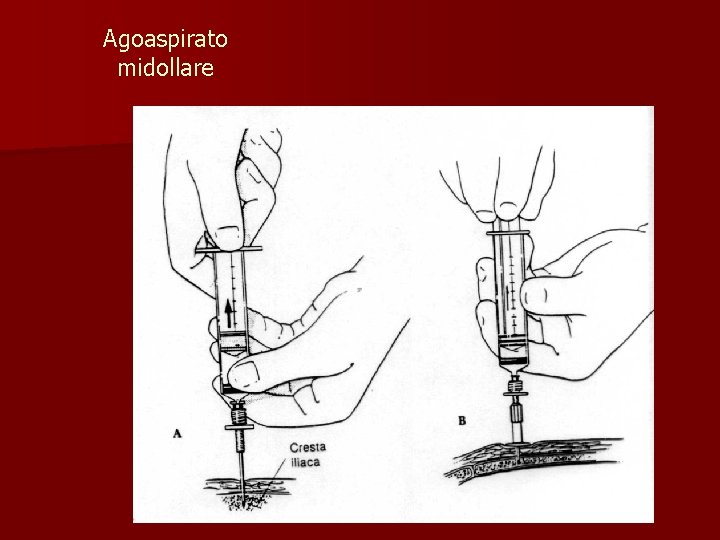 Agoaspirato midollare 