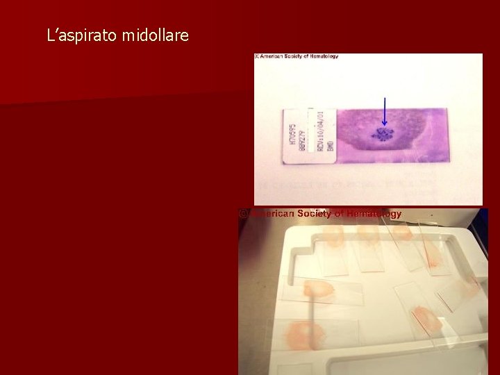 L’aspirato midollare 