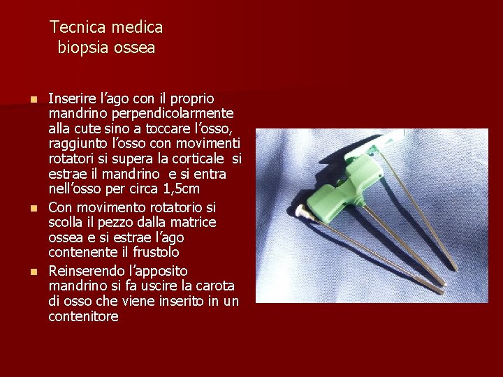 Tecnica medica biopsia ossea Inserire l’ago con il proprio mandrino perpendicolarmente alla cute sino