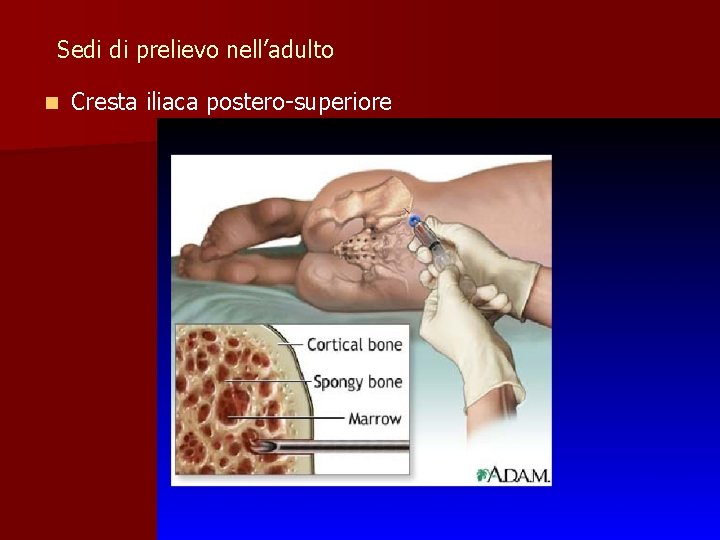 Sedi di prelievo nell’adulto n Cresta iliaca postero-superiore 