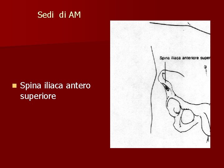 Sedi di AM n Spina iliaca antero superiore 