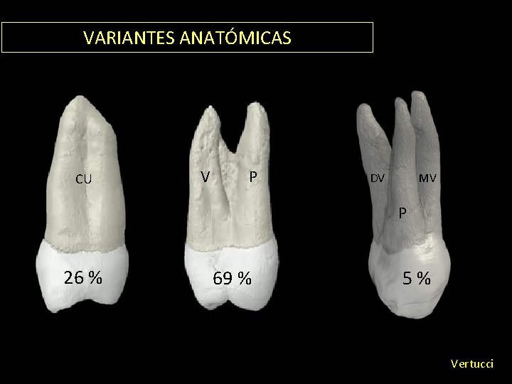 VARIANTES ANATÓMICAS CU V P DV MV P 26 % 69 % 5% Vertucci