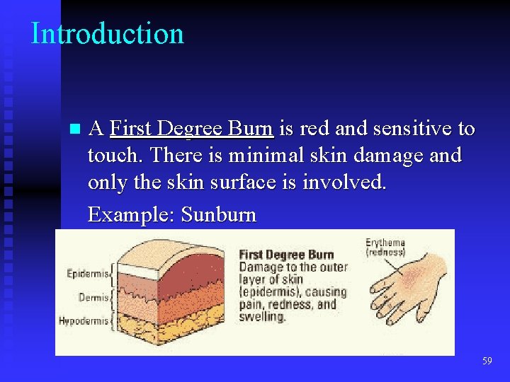 Introduction n A First Degree Burn is red and sensitive to touch. There is Introduction n A First Degree Burn is red and sensitive to touch. There is