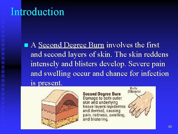 Introduction n A Second Degree Burn involves the first and second layers of skin. Introduction n A Second Degree Burn involves the first and second layers of skin.