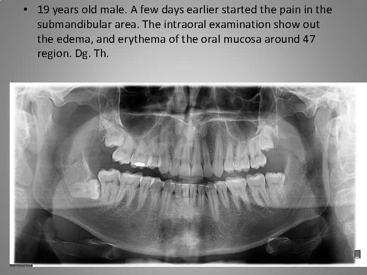  • 19 years old male. A few days earlier started the pain in