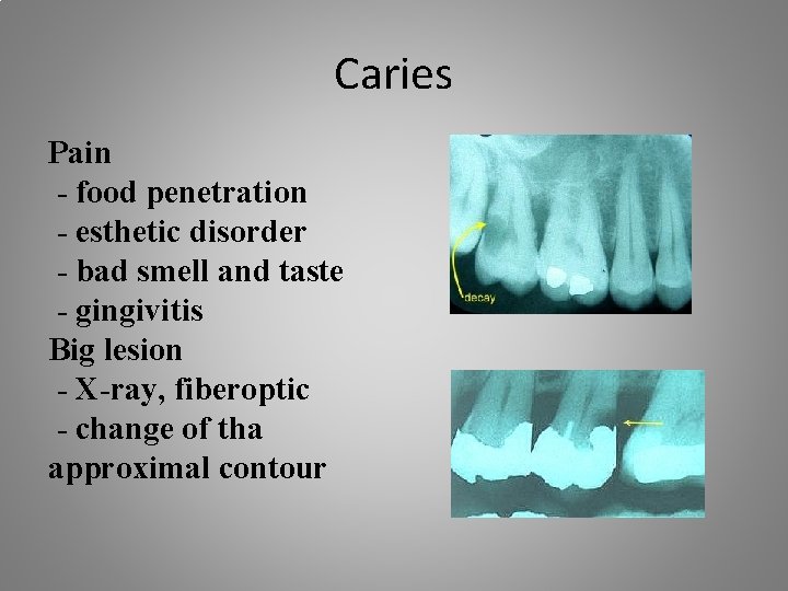 Caries Pain - food penetration - esthetic disorder - bad smell and taste -