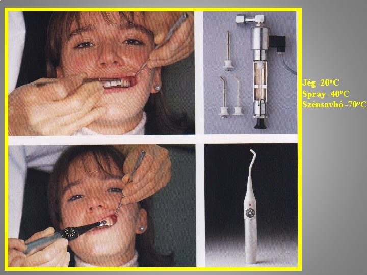 Jég -20 o. C Spray -40 o. C Szénsavhó -70 o. C 