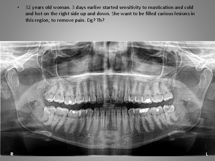  • 32 years old woman. 3 days earlier started sensitivity to mastication and