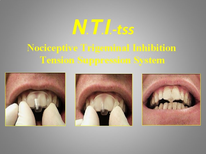 N. T. I. -tss Nociceptive Trigeminal Inhibition Tension Suppression System 