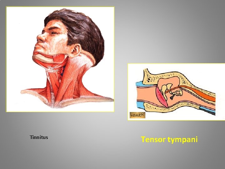 Tinnitus Tensor tympani 