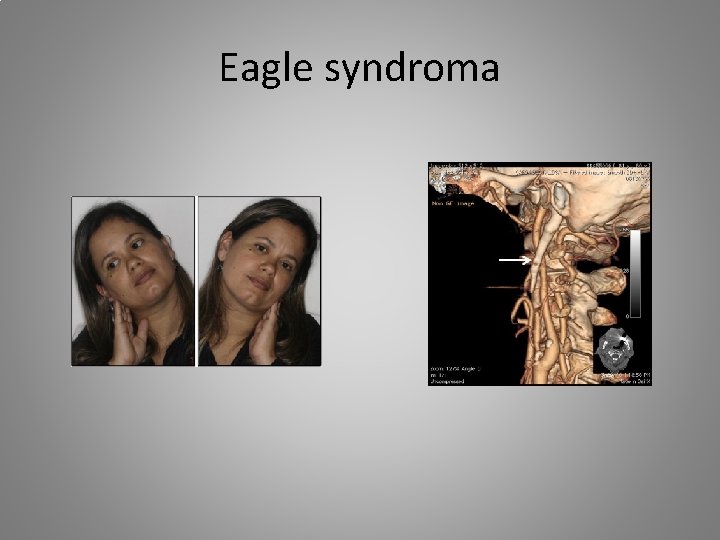 Eagle syndroma 