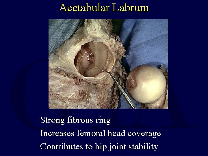 Acetabular Labrum Strong fibrous ring Increases femoral head coverage Contributes to hip joint stability