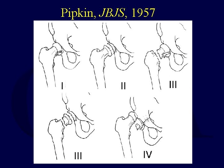 Pipkin, JBJS, 1957 