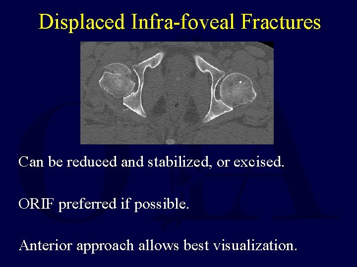 Displaced Infra-foveal Fractures Can be reduced and stabilized, or excised. ORIF preferred if possible.