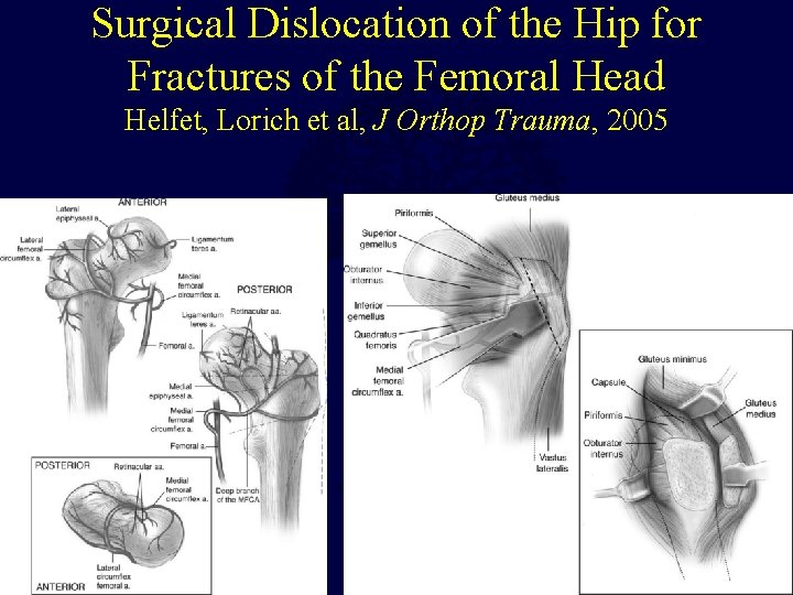 Surgical Dislocation of the Hip for Fractures of the Femoral Head Helfet, Lorich et