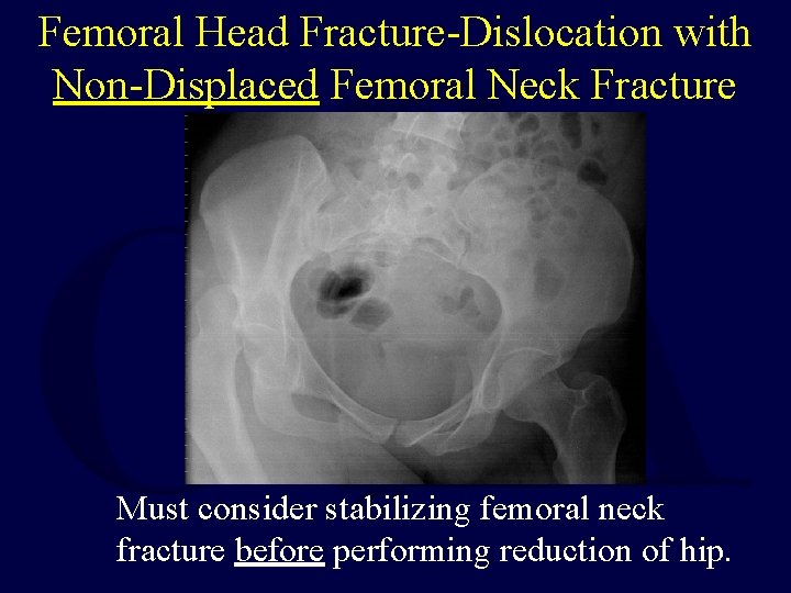 Femoral Head Fracture-Dislocation with Non-Displaced Femoral Neck Fracture Must consider stabilizing femoral neck fracture