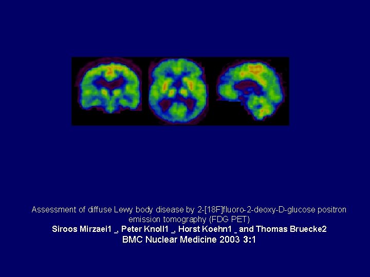 Assessment of diffuse Lewy body disease by 2 -[18 F]fluoro-2 -deoxy-D-glucose positron emission tomography