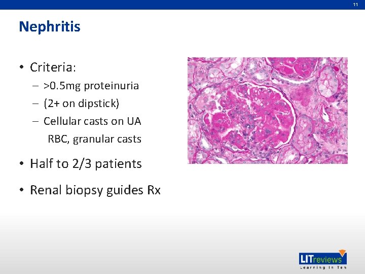 11 Nephritis • Criteria: – >0. 5 mg proteinuria – (2+ on dipstick) –