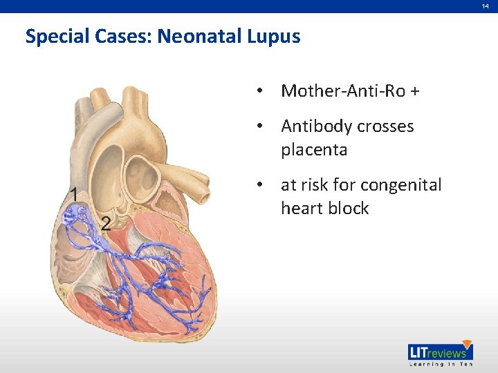 14 Special Cases: Neonatal Lupus • Mother-Anti-Ro + • Antibody crosses placenta • at