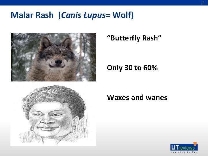 7 Malar Rash (Canis Lupus= Wolf) “Butterfly Rash” Only 30 to 60% Waxes and