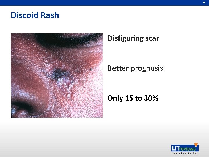 8 Discoid Rash Disfiguring scar Better prognosis Only 15 to 30% 