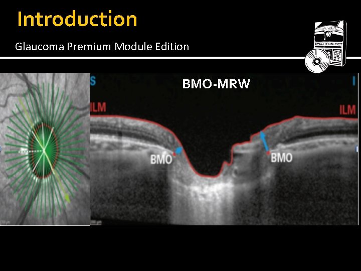 Introduction Glaucoma Premium Module Edition BMO-MRW 