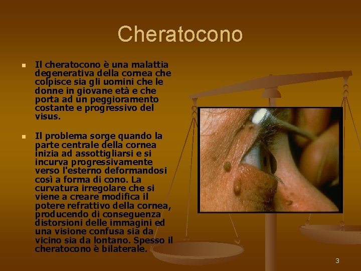 Cheratocono n n Il cheratocono è una malattia degenerativa della cornea che colpisce sia