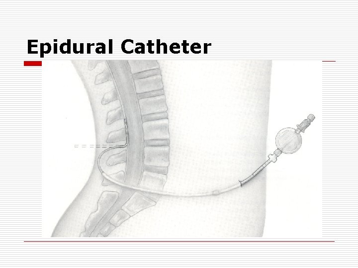 Epidural Catheter Epidural Catheter