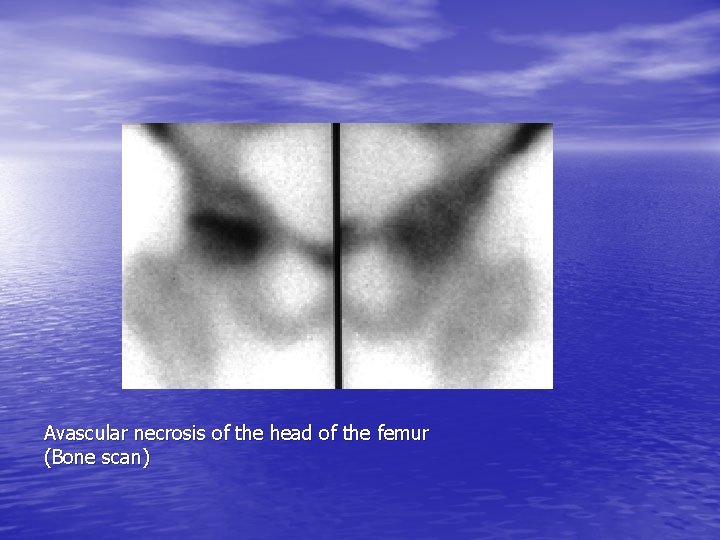 Avascular necrosis of the head of the femur (Bone scan) 