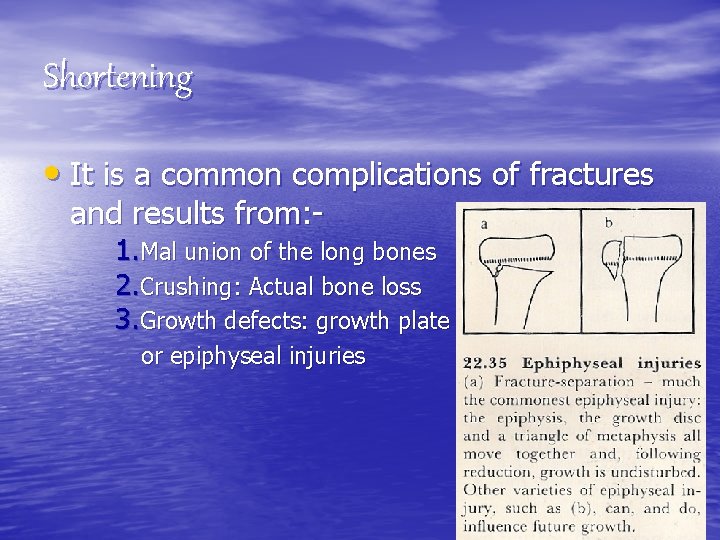 Shortening • It is a common complications of fractures and results from: - 1.