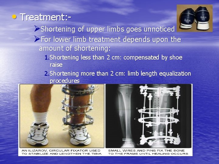  • Treatment: ØShortening of upper limbs goes unnoticed ØFor lower limb treatment depends