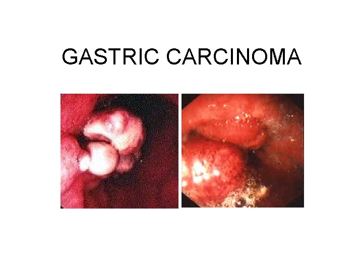 GASTRIC CARCINOMA 