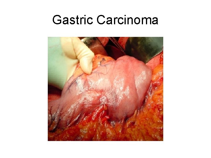 Gastric Carcinoma 