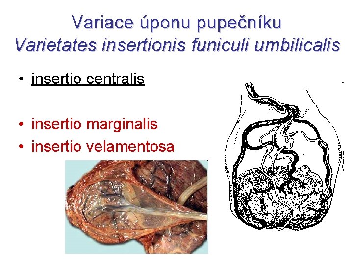 Variace úponu pupečníku Varietates insertionis funiculi umbilicalis • insertio centralis • insertio marginalis •