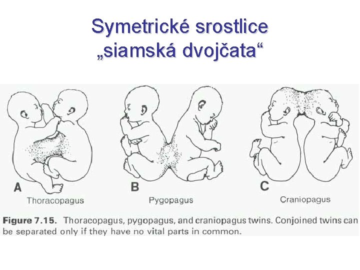 Symetrické srostlice „siamská dvojčata“ 