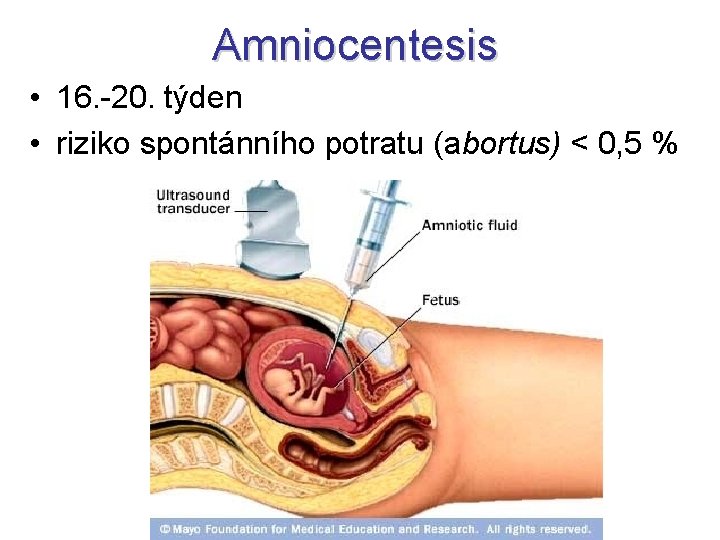 Amniocentesis • 16. -20. týden • riziko spontánního potratu (abortus) < 0, 5 %