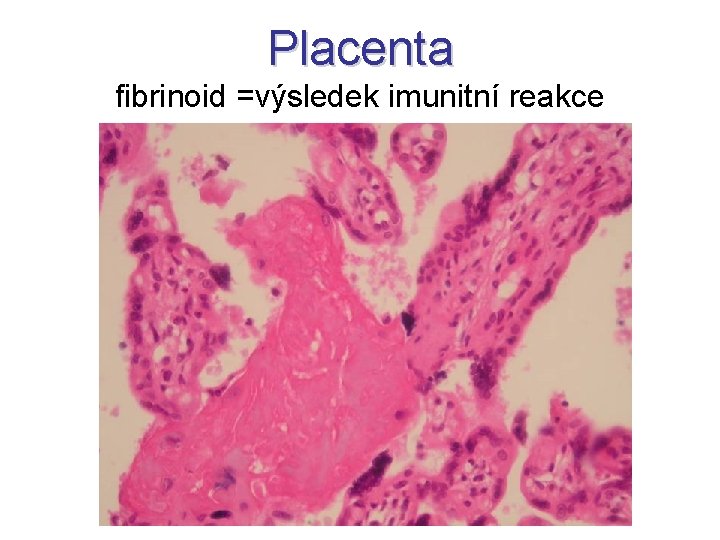 Placenta fibrinoid =výsledek imunitní reakce 