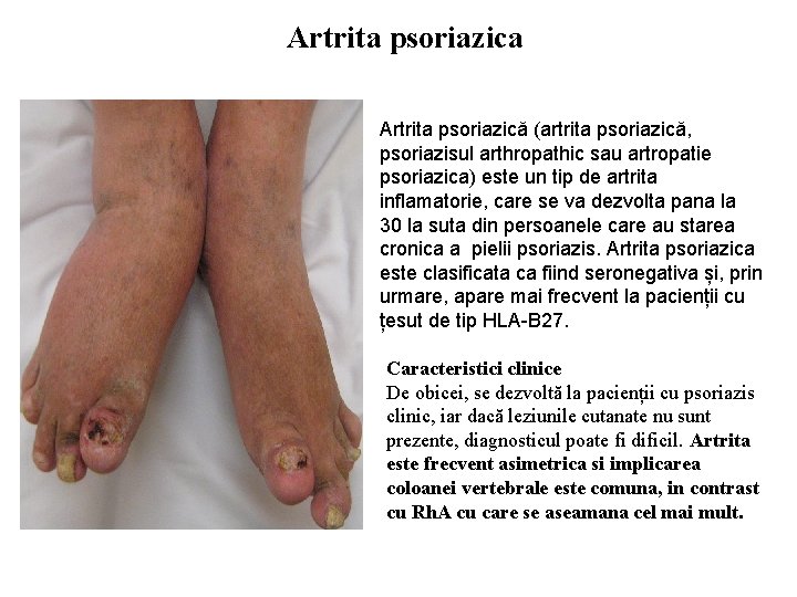 artrita migratorie asimetrica)