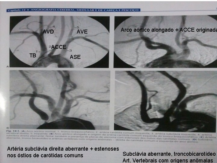 AVD AVE Arco aórtico alongado + ACCE originada ACCE TB ASE Artéria subclávia direita