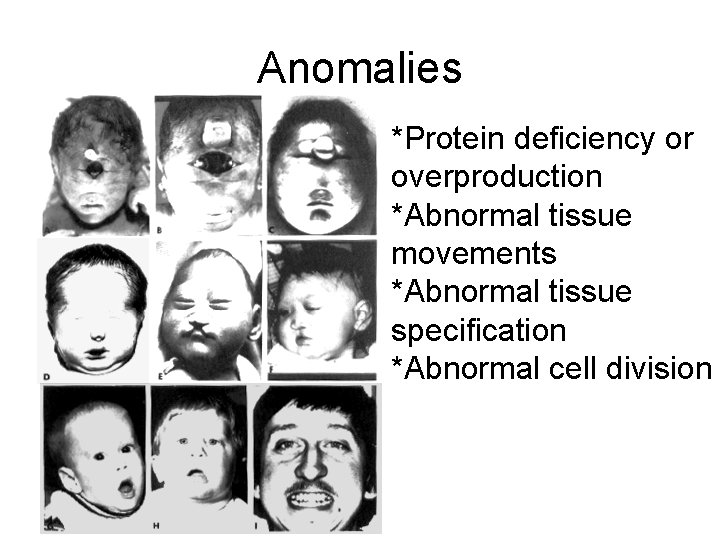 Anomalies *Protein deficiency or overproduction *Abnormal tissue movements *Abnormal tissue specification *Abnormal cell division Anomalies *Protein deficiency or overproduction *Abnormal tissue movements *Abnormal tissue specification *Abnormal cell division