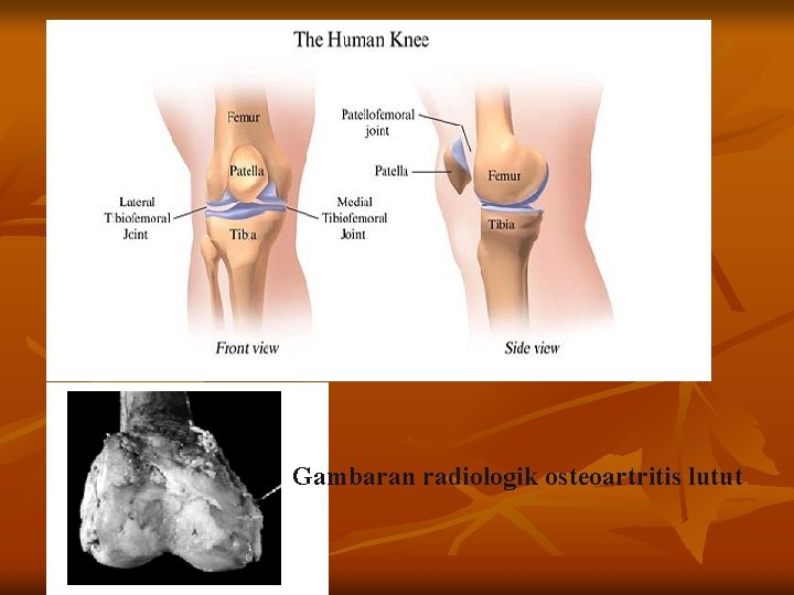 Gambaran radiologik osteoartritis lutut 