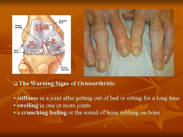 q The Warning Signs of Osteoarthritis: • stiffness in a joint after getting out